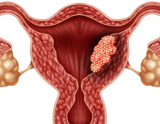 Mitos Kanker Serviks yang Bikin Salah Kaprah