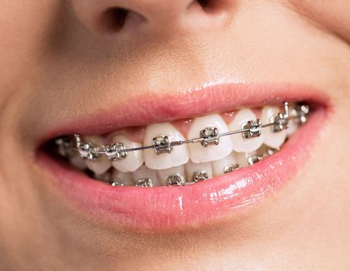 Cara Atasi Gigi Sensitif pada Pengguna Behel