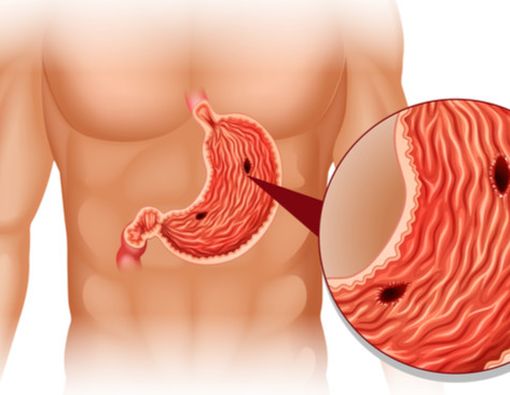 Sakit Mag Tak Kunjung Sembuh, Apa Penyebabnya?
