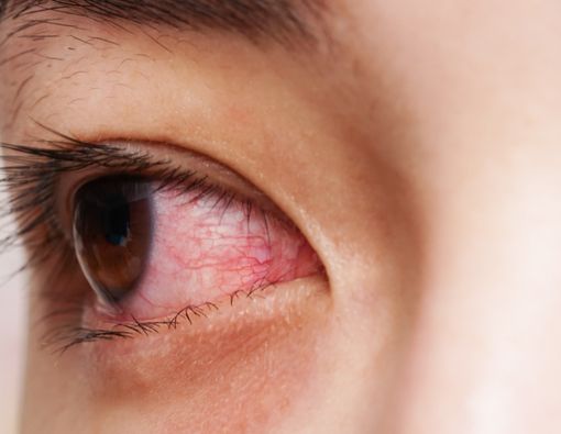 Efek Kabut Asap Akibat Kebakaran Hutan pada Kesehatan Mata