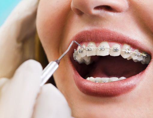 Pasang Behel di Tukang Gigi, Ini Risikonya!