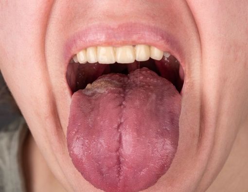 Benarkah Oral Seks Bisa Sebabkan Kanker Mulut?