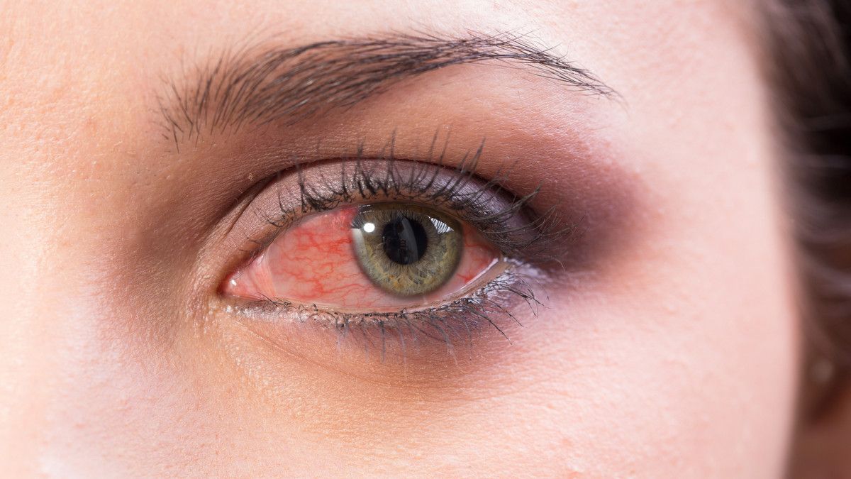 Kenali Penyebab Mata Merah dan Cara Mengatasinya
