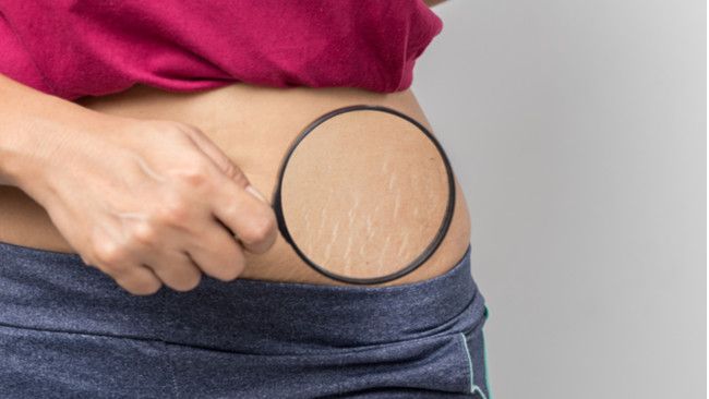 Tips Menghilangkan Stretch Mark Secara Alami