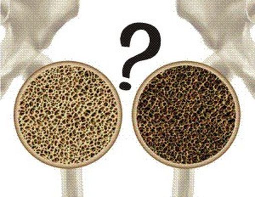 Kenapa Tulang Bisa Keropos?