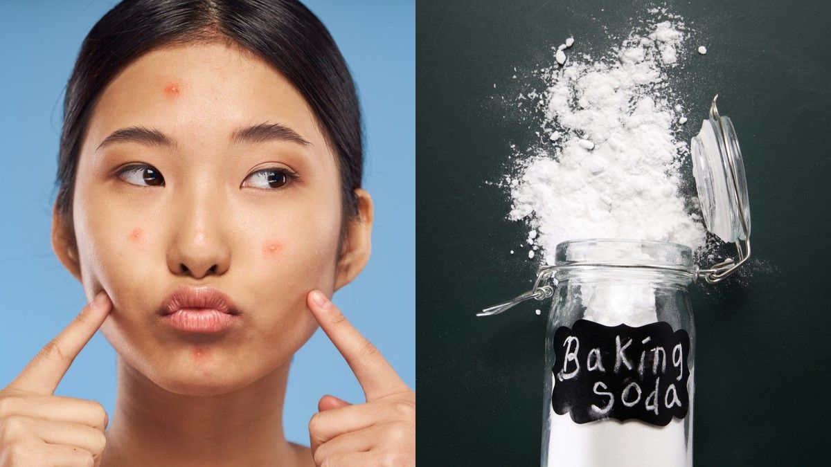 Fakta Penggunaan Baking Soda untuk Hilangkan Jerawat