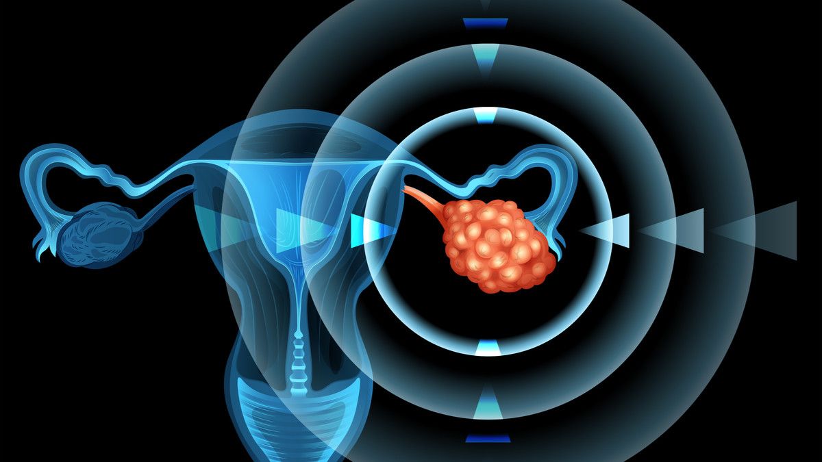 Gejala Kanker Ovarium yang Harus Diwaspadai Wanita