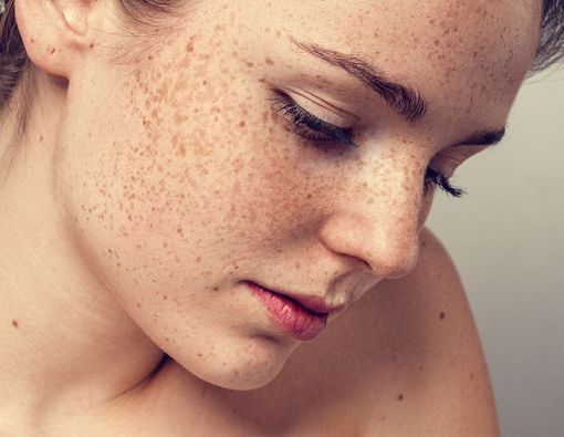 Mitos dan Fakta tentang Freckles