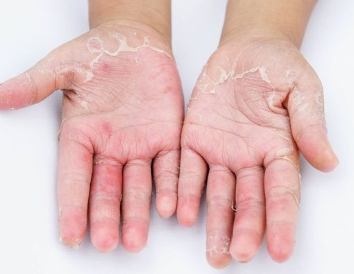 Bukan Penyakit Kulit Biasa, Kenali Penyebab Dermatitis Stasis