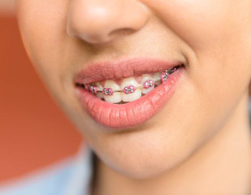 Orang Dewasa Masih Bisa Pakai Kawat Gigi?