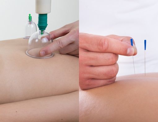 Terapi Bekam dan Akupunktur, Mana Lebih Baik untuk Obati Penyakit?