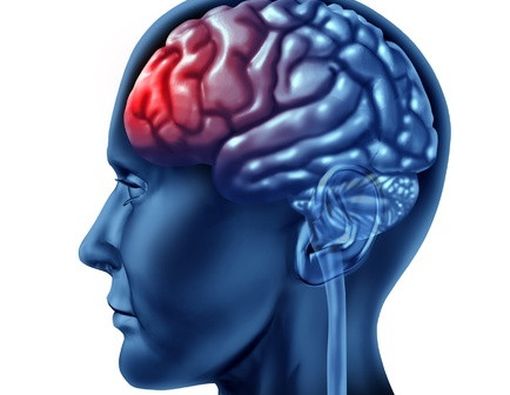 Waspadai Perdarahan di Dalam Otak!