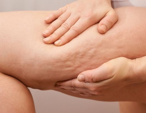 Benarkah Pijat Bisa Menghilangkan Selulit?