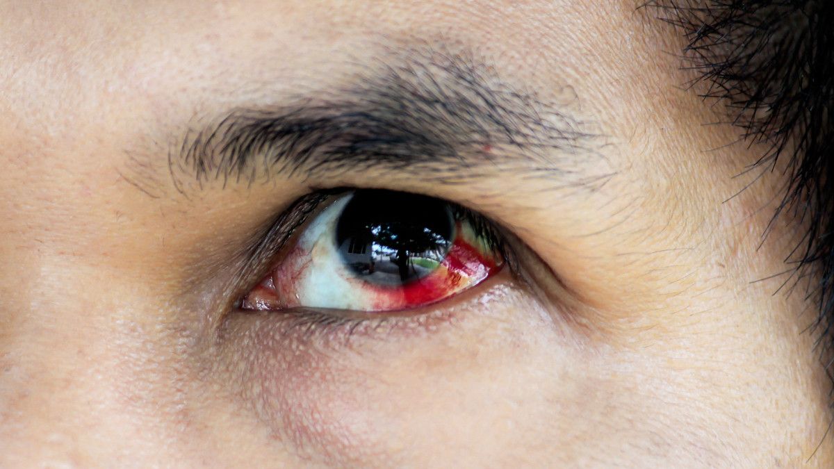 Mengetahui Penyebab dan Faktor Risiko Perdarahan Mata Bawah