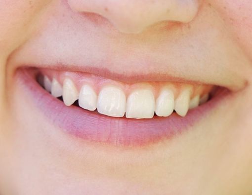 Muncul Bercak Putih di Gigi, Ini Penyebabnya