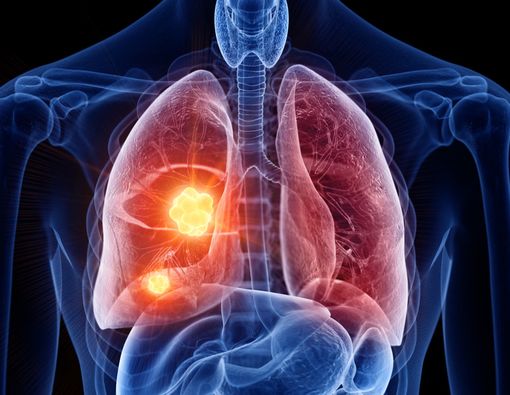 Penyebab Kanker Paru, Tak Hanya dari Rokok