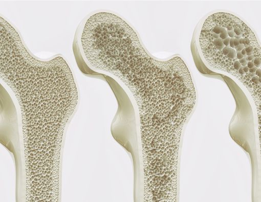 Osteoporosis, Penyakit Orang Tua yang Bisa Dicegah Sejak Muda