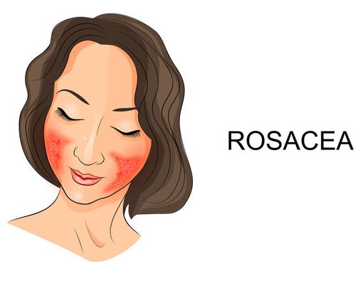 7 Makanan Ini Memicu Gangguan Kulit Rosacea