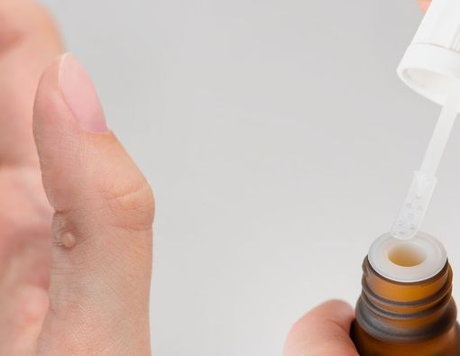 6 Jenis Obat Medis Penghilang Kutil