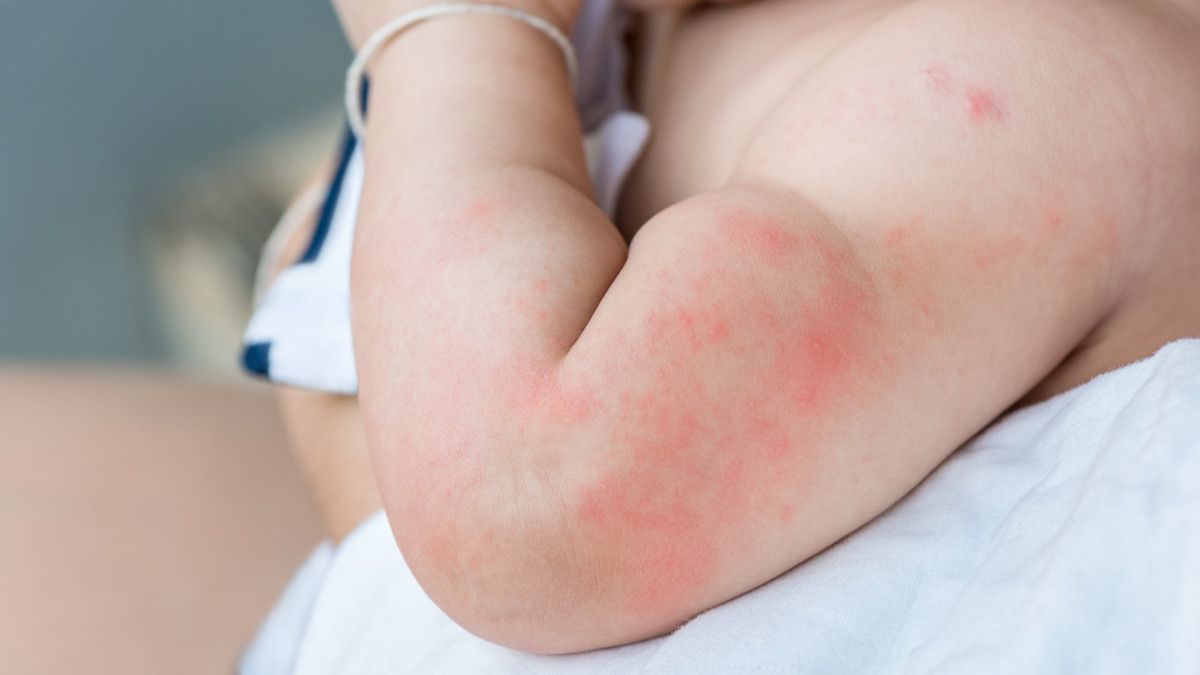 Herpes Simpleks pada Bayi, Bisakah Disembuhkan?