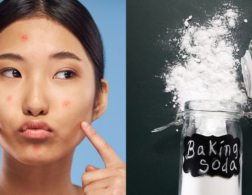 Fakta Penggunaan Baking Soda untuk Hilangkan Jerawat