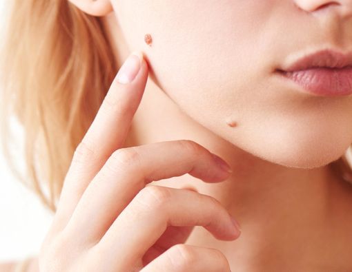 Amankah Menghilangkan Tahi Lalat Sendiri?