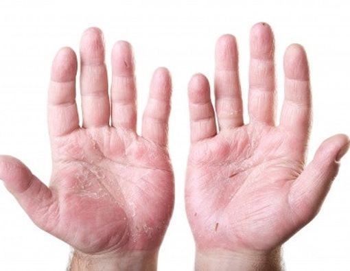 7 Tips Cegah Eksim Pada Anak