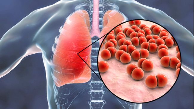 Pneumonia, Penyakit Paru yang Bisa Sebabkan Kematian