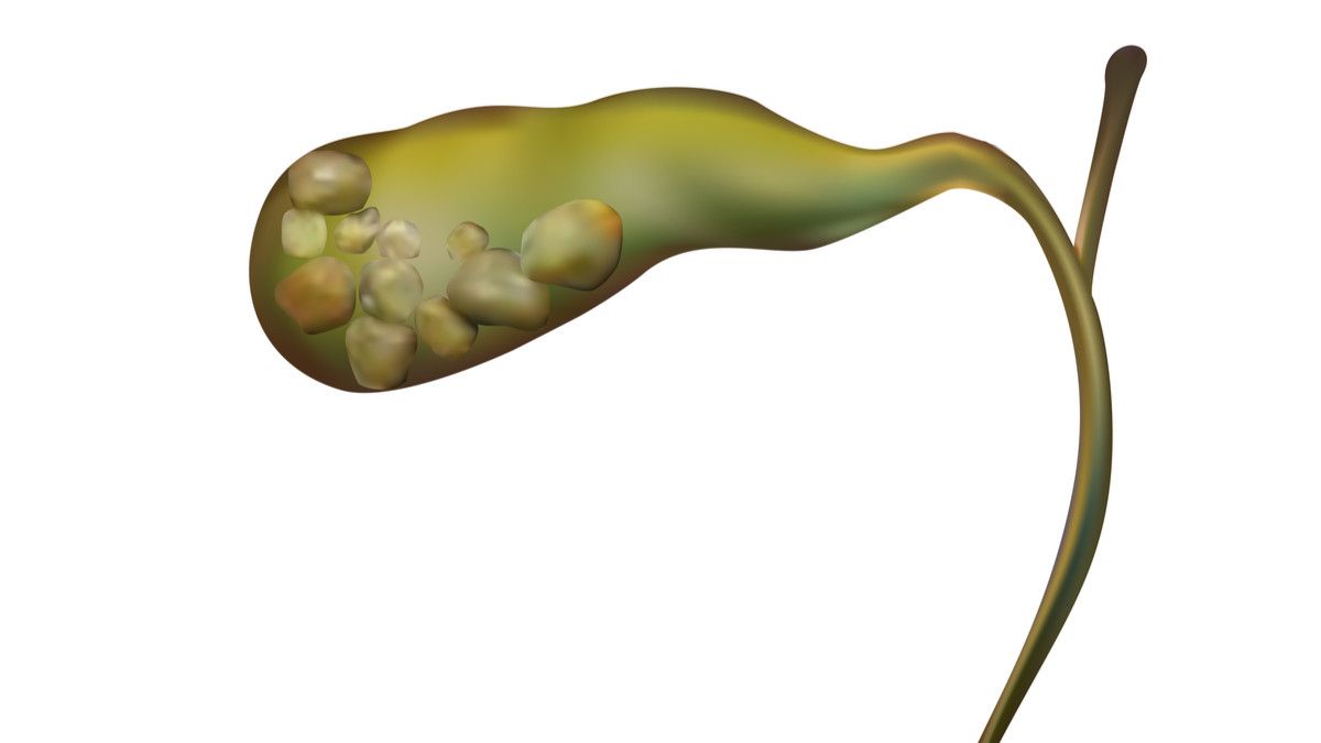 Pola Makan Sehat Usai Operasi Batu Empedu