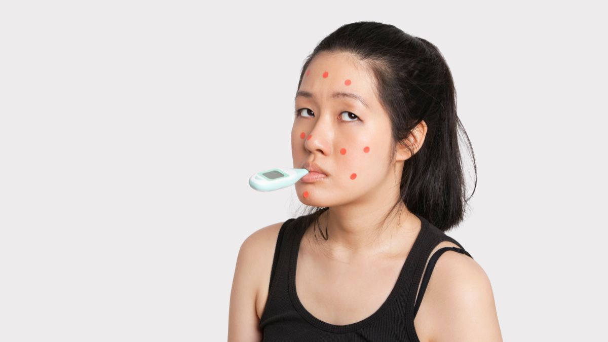 10 Cara Menghilangkan Bopeng Bekas Cacar Air Secara Alami dan Medis