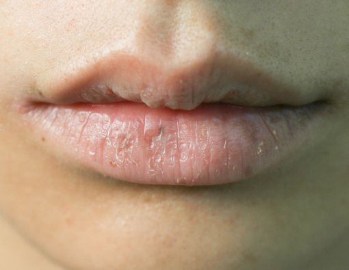 Sariawan di Bibir Kering, Bolehkah Dibiarkan?