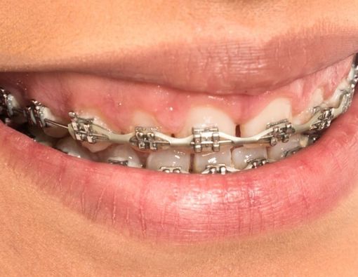 Manfaat dan Risiko Penggunaan Power Chain Braces