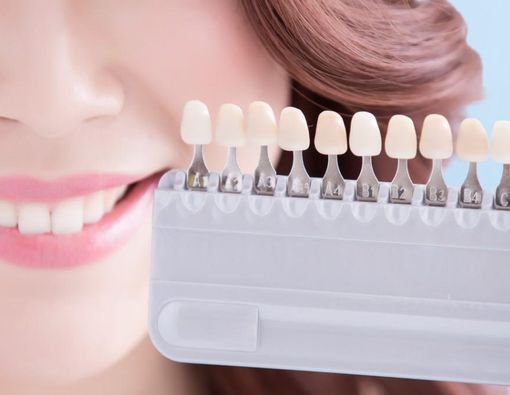Penyebab dan Cara Mengatasi Veneer Gigi yang Menguning