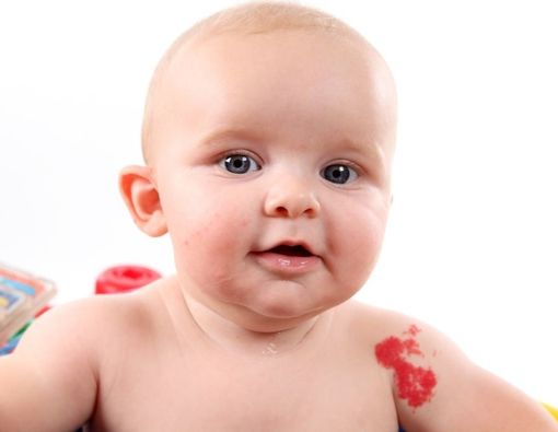 Apakah Tanda Lahir pada Bayi Berbahaya? Cek di Sini