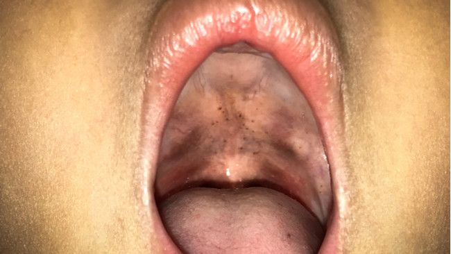 Ini 4 Alasan Mengapa Difteri Bisa Mengancam Nyawa