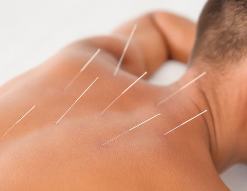 Menikmati Berbagai Manfaat Akupunktur bagi Kesehatan