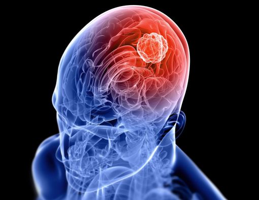 Waspadai 5 Gejala Tumor Otak yang Diam-diam Menyerang