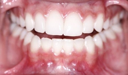 Kok Bisa Berdarah Ketika Menyikat Gigi?