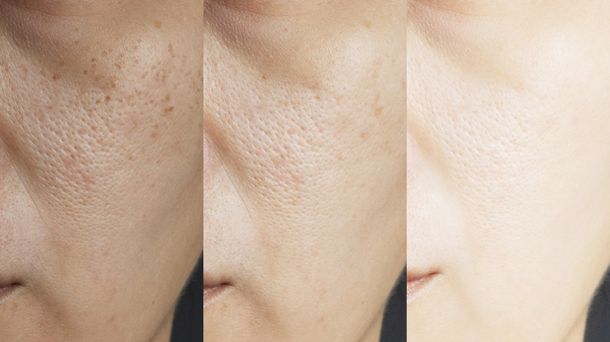 berapa mg glutathione untuk memutihkan kulit Tren Memutihkan Kulit dengan Glutathione, Amankah?