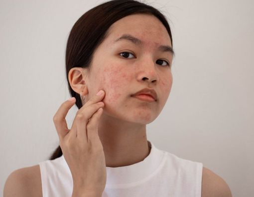 12 Makanan Penyebab Jerawat yang Mesti Kamu Hindari