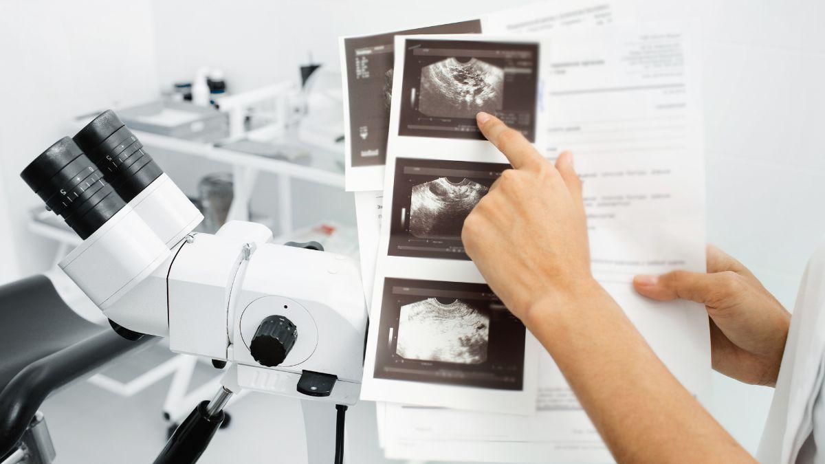 5 Cara Mendiagnosis Kista Ovarium
