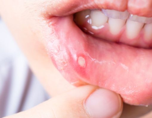 Cara Mengobati Sariawan Saat Puasa