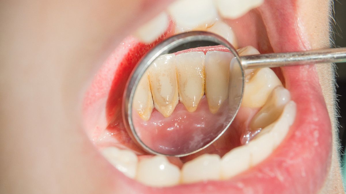 Ilustrasi Plak pada Gigi