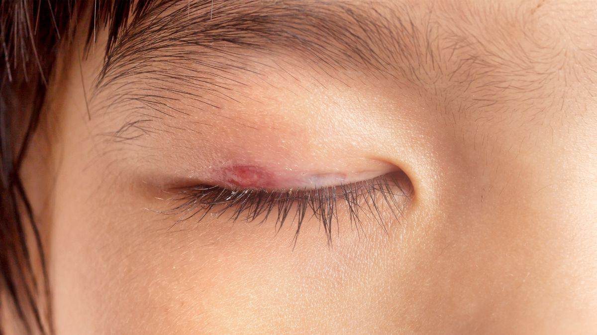 5 Pilihan Obat yang Efektif Mengatasi Mata Bintitan