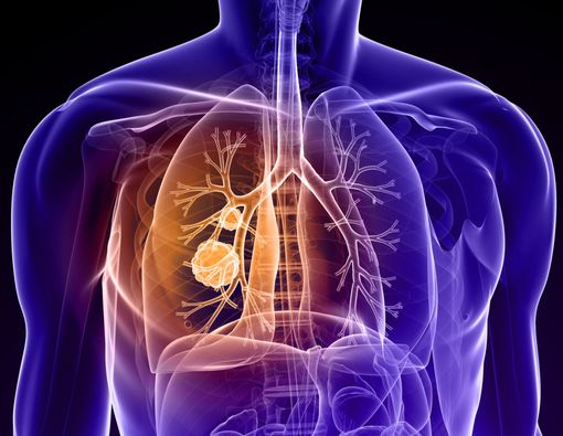 Kenali Seluk-beluk Imunoterapi untuk Kanker Paru