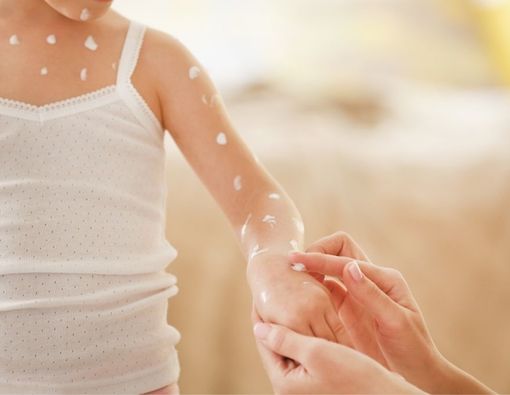 Kiat Efektif Mengobati Cacar Air pada Anak