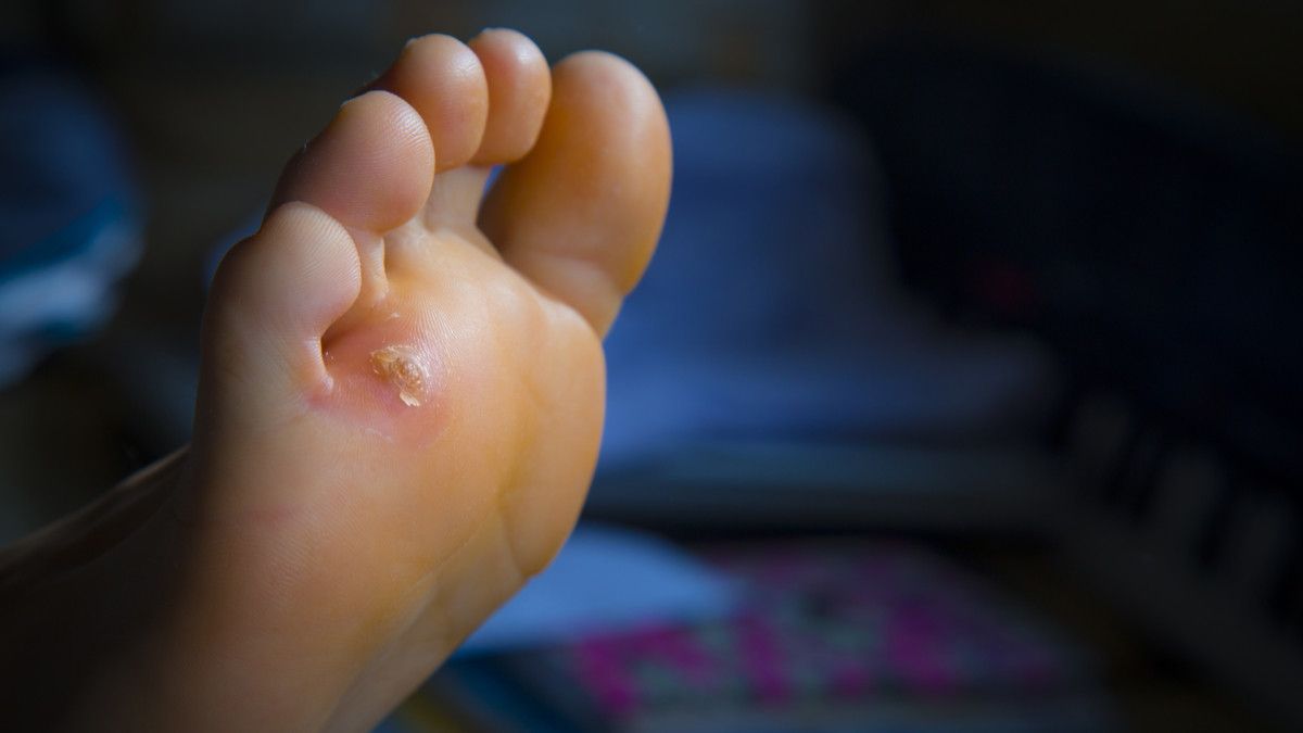 Tips Mudah Mengatasi Mata Ikan di Kaki