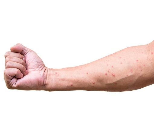 5 Tips agar Cacar Air Tidak Membekas