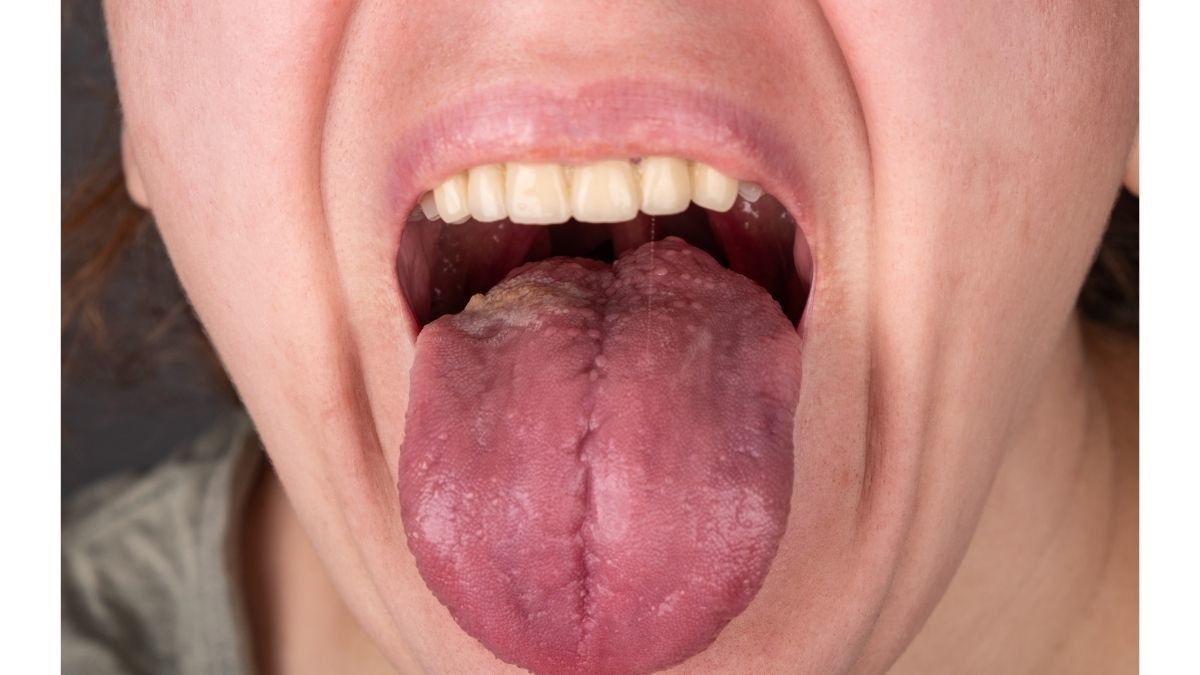 Benarkah Oral Seks Bisa Sebabkan Kanker Mulut?