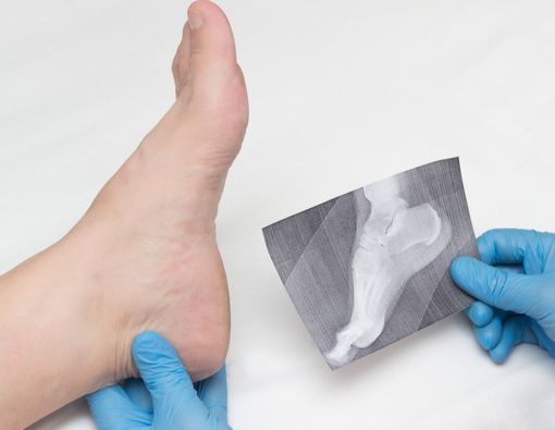 Ini Dia 4 Gejala Pengapuran Tulang yang Harus Anda Tahu